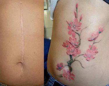 Можно ли делать татуировку на шраме